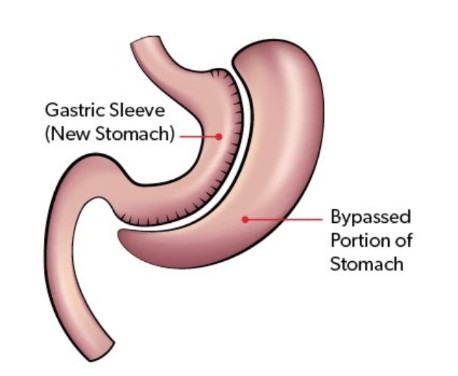 Diet Made Simple: High-Protein After Gastric Sleeve (2026)